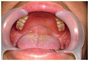 図5:寝たきりで清掃状態が悪く、口腔内にカンジダ菌発生していることを示す写真