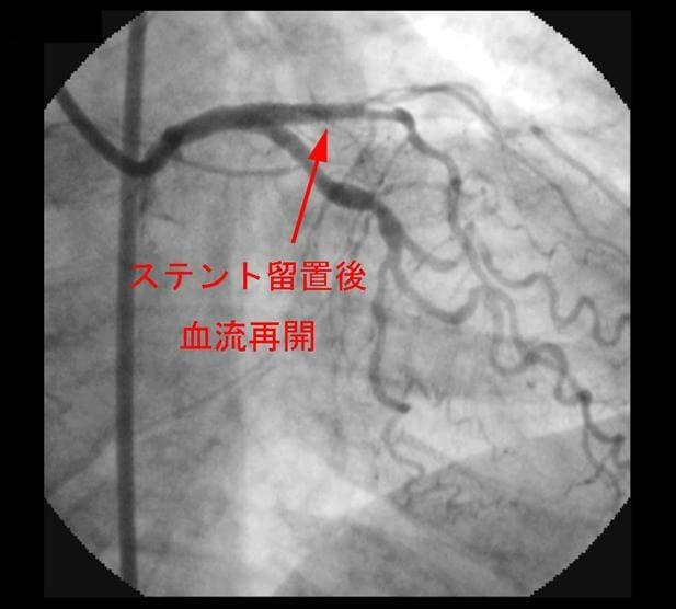 左前下行枝近位部でステント拡張後血流再開を示す例の造影写真