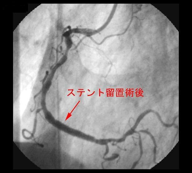 図6：ステント留置術後の脳画像