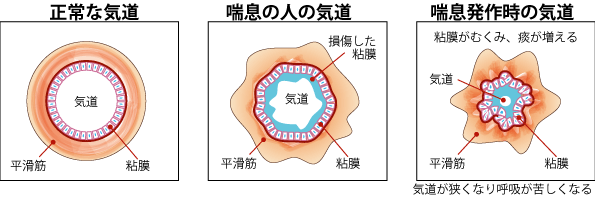図:正常な気道と喘息の人の気道と喘息発作時の気道を示した図。喘息の人の気道、発作時の気道に狭窄が見られることを表す。