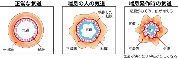 図：正常な気道と喘息の人の気道と喘息発作時の気道を示した図。喘息の人の気道、発作時の気道に狭窄が見られることを表す。