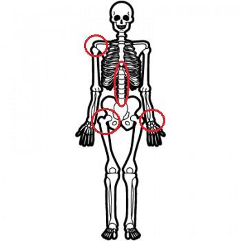図：高齢者の骨折部位を示すイラスト