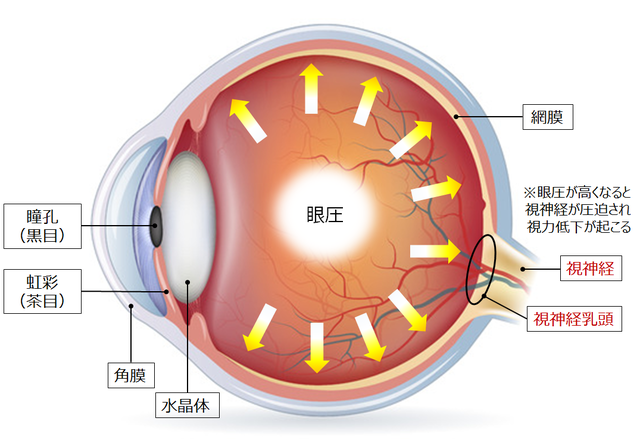 図1：眼球の断面図。何らかの要因で眼の中の眼圧が高まり、視神経が圧迫され視力低下が起こることを示している