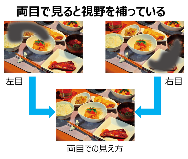 図1：緑内障を発症している人の見え方を示す図。左右それぞれの目が見えない視野を両目で補っていることを表している