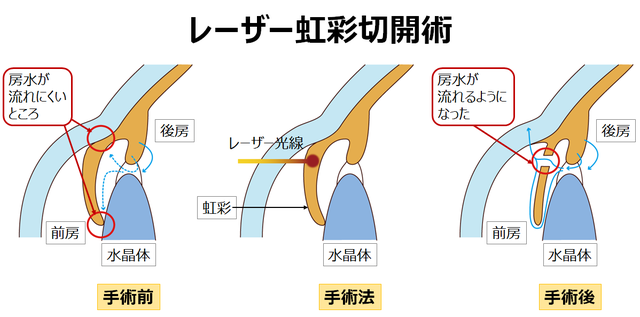 図2：レーザー虹彩切開術を示す図。虹彩（茶目）の房水が流れにくいところにレーザー光線をあてて孔を開け、眼内の房水の流れを変えていることを表している。