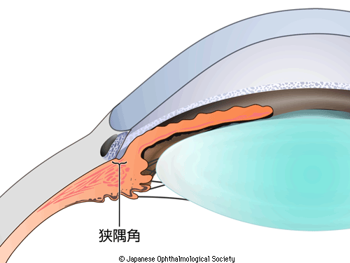 図3：峡隅角を示す図。隅角が狭くなっていることを示す。