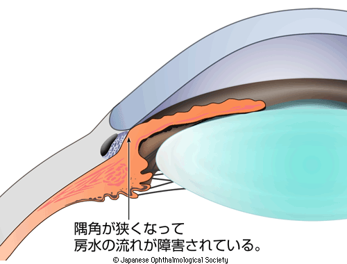 図4：閉塞隅角を示す図。隅角が閉じてしまって房水の流れが障害されていることを示す。