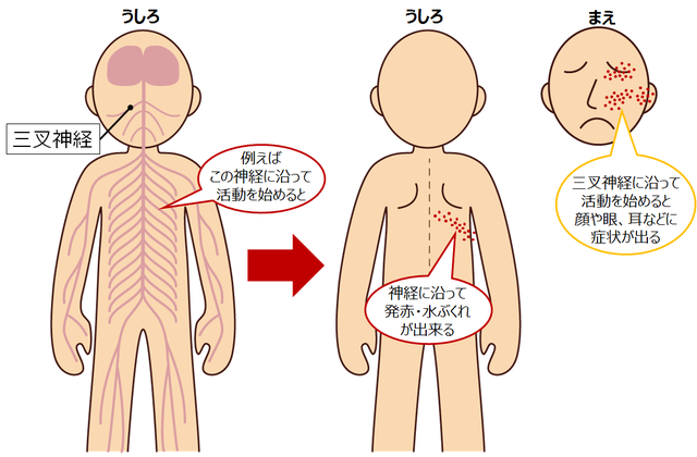 図2：神経の流れに沿って帯状疱疹による皮膚症状があらわれることを示す図。例えば背中の神経に沿ってウイルスが活動を始めると、神経に沿って皮膚が発赤、水ぶくれができる。また、顔の三叉神経に沿ってウイルスが活動を始めると顔や眼、耳などに皮膚症状が出る。