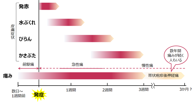 図：一般的な帯状疱疹の経過を示す図。発症の数日～1週間前は前駆痛があり、発症すると神経の走行に沿って発疹が帯状に広がる。発症後数日～2週間に、発疹部分が水ぶくれとなりただれてくる（びらん）。この時神経痛が伴う。発症から2～3週間後にかさぶたとなって自然とはがれる。慢性的な神経痛が残る人もいる。