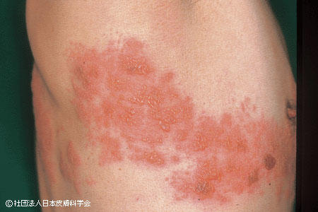 写真：帯状疱疹による発疹（皮疹）。右わき下部分に発疹が確認できる