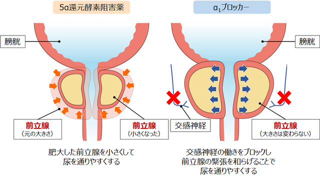 図：前立腺肥大症のお薬による効果の違いを示す図。5a還元酵素阻害薬は肥大した前立腺を小さくして、尿を通りやすくする。a1ブロッカーは交感神経の働きをブロックし、前立腺の緊張を和らげることで尿を通りやすくする。