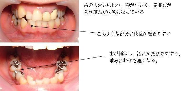 写真：歯並び、噛み合わせを説明する写真。歯の大きさに比べあごが小さく、歯並びが入り組んだ状態は、歯茎に炎症が起きやすいことを示している。また、歯が傾斜し、汚れがたまりやすく、噛み合わせも悪くなることを示している。