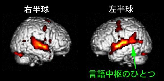 図：朗読の聞き取りによって活動した脳部位を示す脳の画像。左半球の画像において、言葉の理解に重要な部位である言語中枢の一つが赤く表示されていることから、この部分の活動が活発であることを表している。