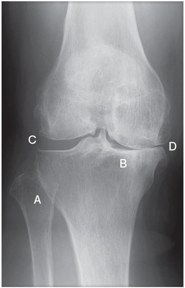 図1：膝関節を立位で撮影した正面像で、変形性膝関節症の症状を示す。