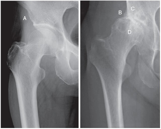 図2：正常な股関節と変形性股関節の症状を比較した図。