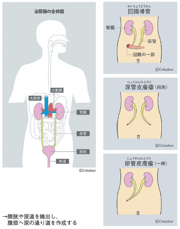 図2：泌尿器の全体図と尿路変更の回腸導管、尿管皮膚瘻、尿管皮膚瘻の3種類を示す図。