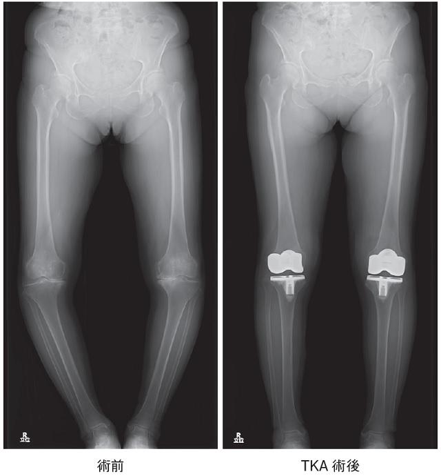 図2：変形性膝関節症の術前とTKA術後の症例を表す人工膝関節の写真。