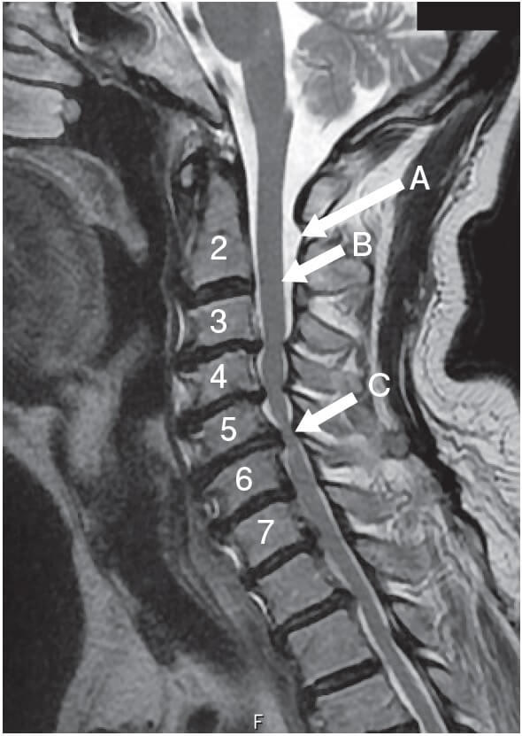 図3：頚椎症性脊髄症の症状を示す図。頸椎で脊髄が圧迫されている様子を表す。