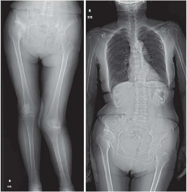 図3：股関節変形に伴う脊柱変形の症例を表す写真。
