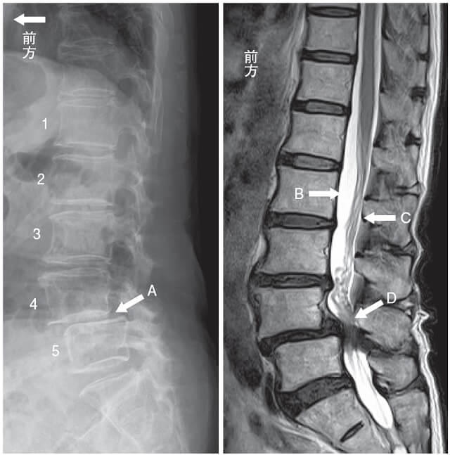 図4：腰椎変性すべり症に伴う腰部脊柱管狭窄症による神経が圧迫された様子を表す図。