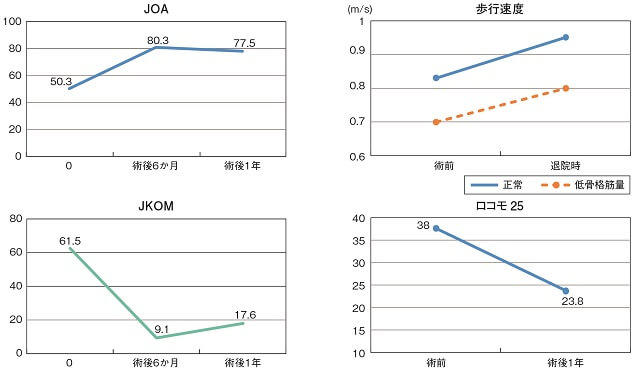 図5:TKA術前、術後でのJOA、歩行速度、JKOM、ロコモ25の成績評価を表すグラフ。