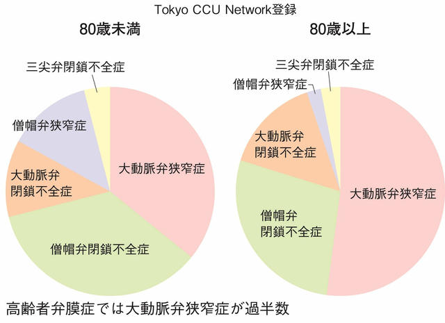 図：心不全で入院した弁膜症の内訳。2011年東京CCUネットワーク登録症例において、80歳未満では大動脈弁狭窄症と僧帽弁閉鎖不全症がそれぞれ３割程度であるのに対して、80歳以上では大動脈弁狭窄症が過半数以上を占めている事を示す円グラフ