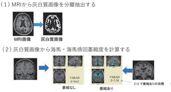 VSEADを用いて海馬・海馬傍回の萎縮度を表す数値を算出する様子を表した図